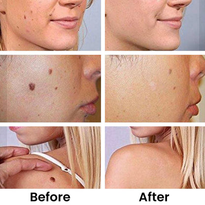 ✨Tags & Moles Remover ( Buy 1 Get 1 Free )✨