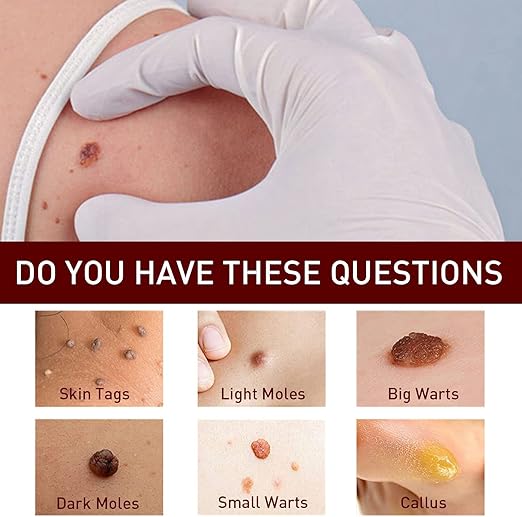 ✨Tags & Moles Remover ( Buy 1 Get 1 Free )✨