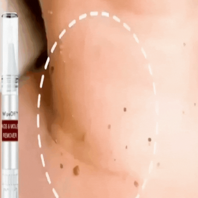 ✨Tags & Moles Remover ( Buy 1 Get 1 Free )✨