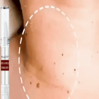 ✨Tags & Moles Remover ( Buy 1 Get 1 Free )✨